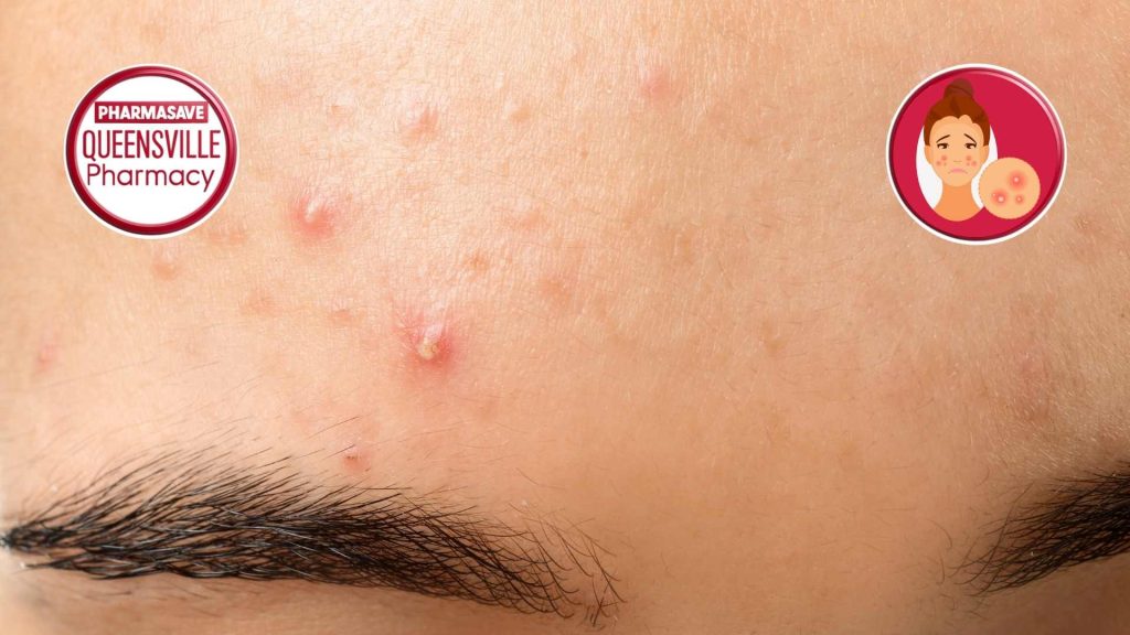 Close-up of forehead showing acne.