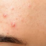 Close-up of forehead showing acne.