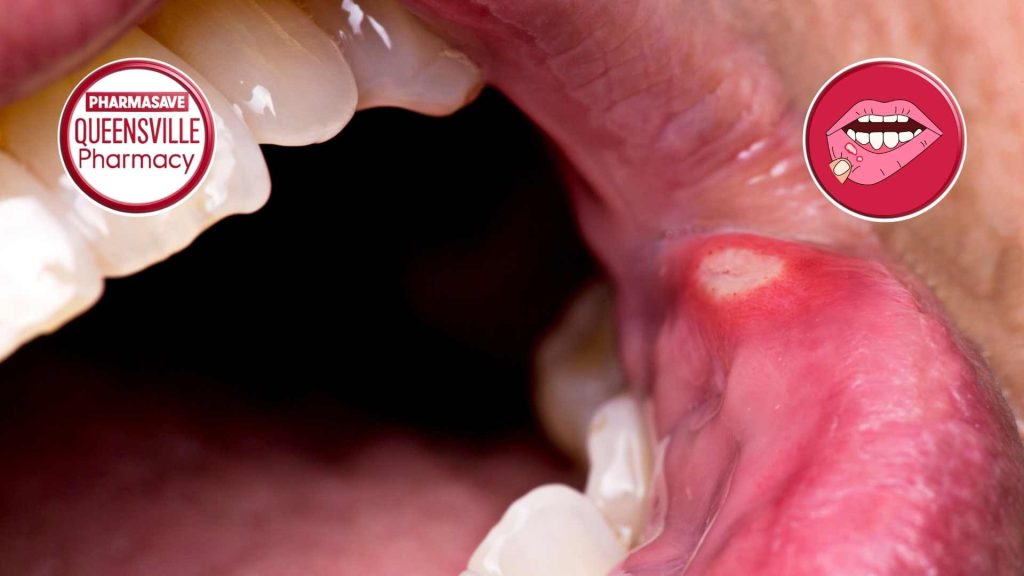 Open mouth, close-up, showing canker sore