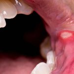 Open mouth, close-up, showing canker sore