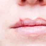 Close-up of lips with cold sore.