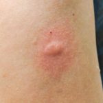 Image of forearm showing reaction to insect bite.