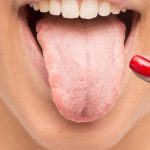Close-up of tongue showing oral thrush.