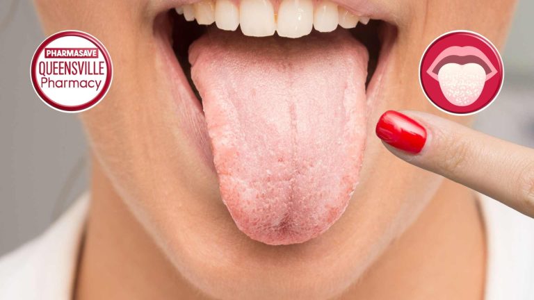 Close-up of tongue showing oral thrush.