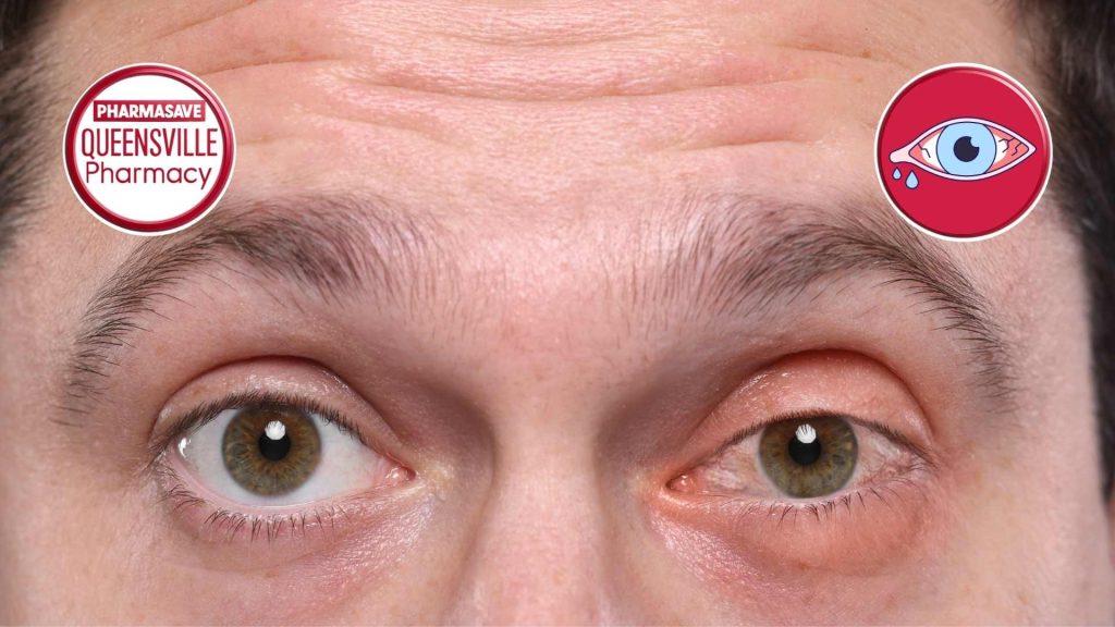Close-up of man's eyes, left eye has pink eye.