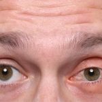 Close-up of man's eyes, left eye has pink eye.