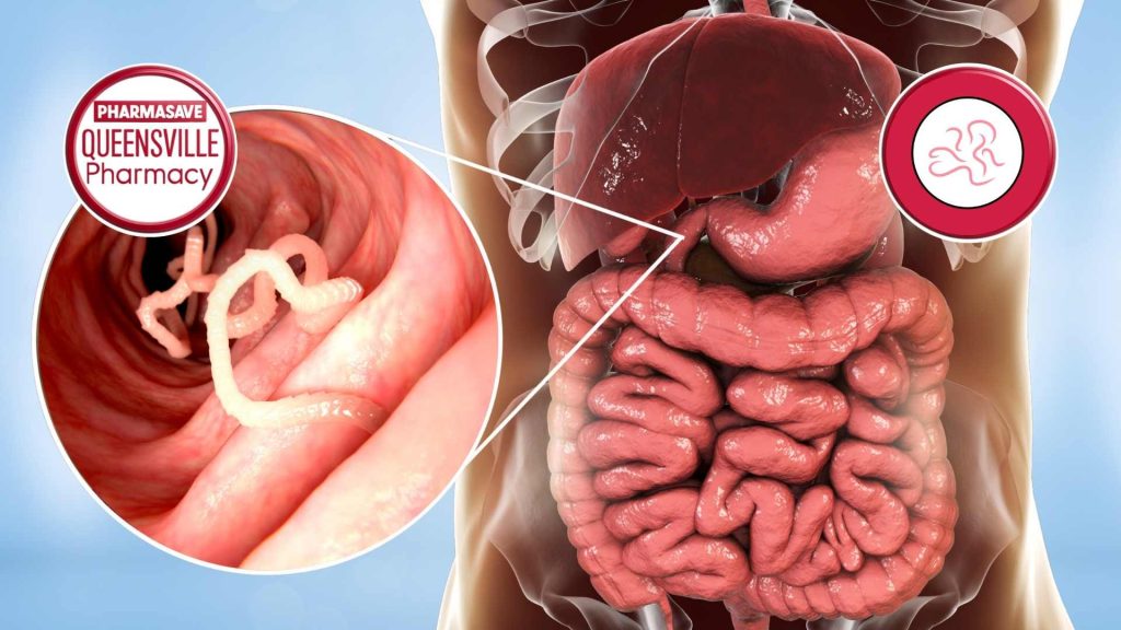 Intestinal image with insert showing pinworms.
