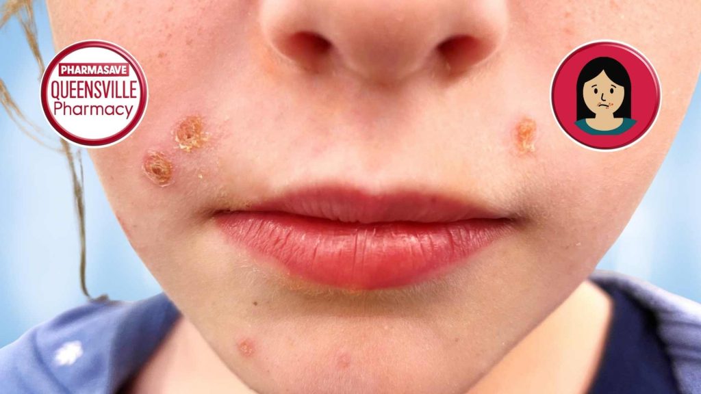 Close-up of young woman's face showing skin infections.