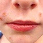 Close-up of young woman's face showing skin infections.