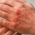 Close-up of a man's hands, the back side of the left hand showing dermatitis.