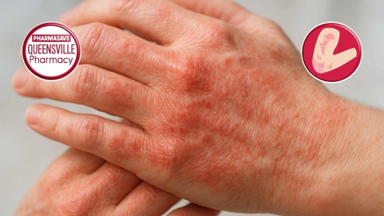 Close-up of a man's hands, the back side of the left hand showing dermatitis.